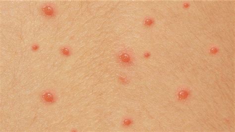 Bulutong (Chickenpox) .